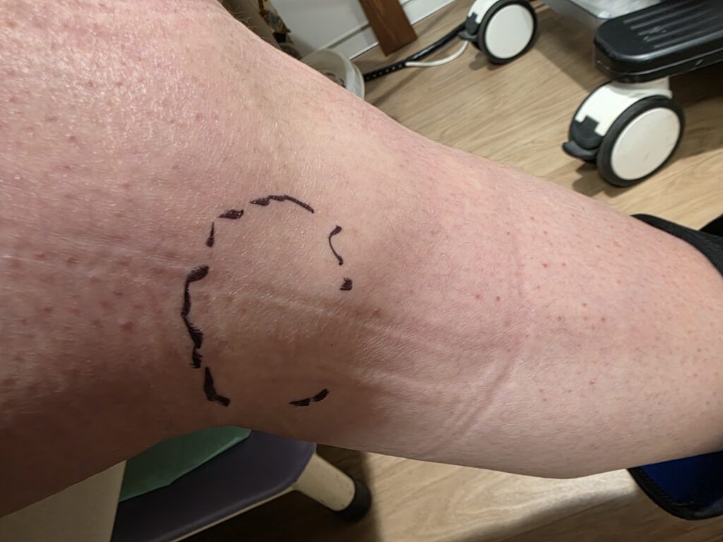 LIPUS照射位置を示すため医師が膝に付けたマーキング