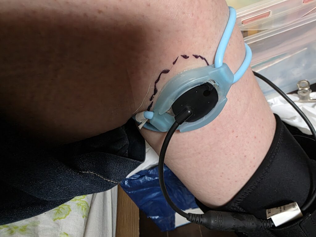 膝の骨挫傷にLIPUS（リーパス）を照射している実際の使用例